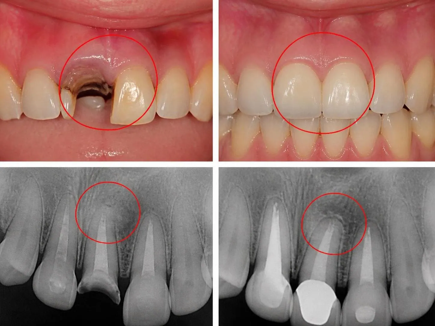[경산 명치과] 명치과 (myungdental) 자연치아 살리기 메인 보존 보철 통합 치료