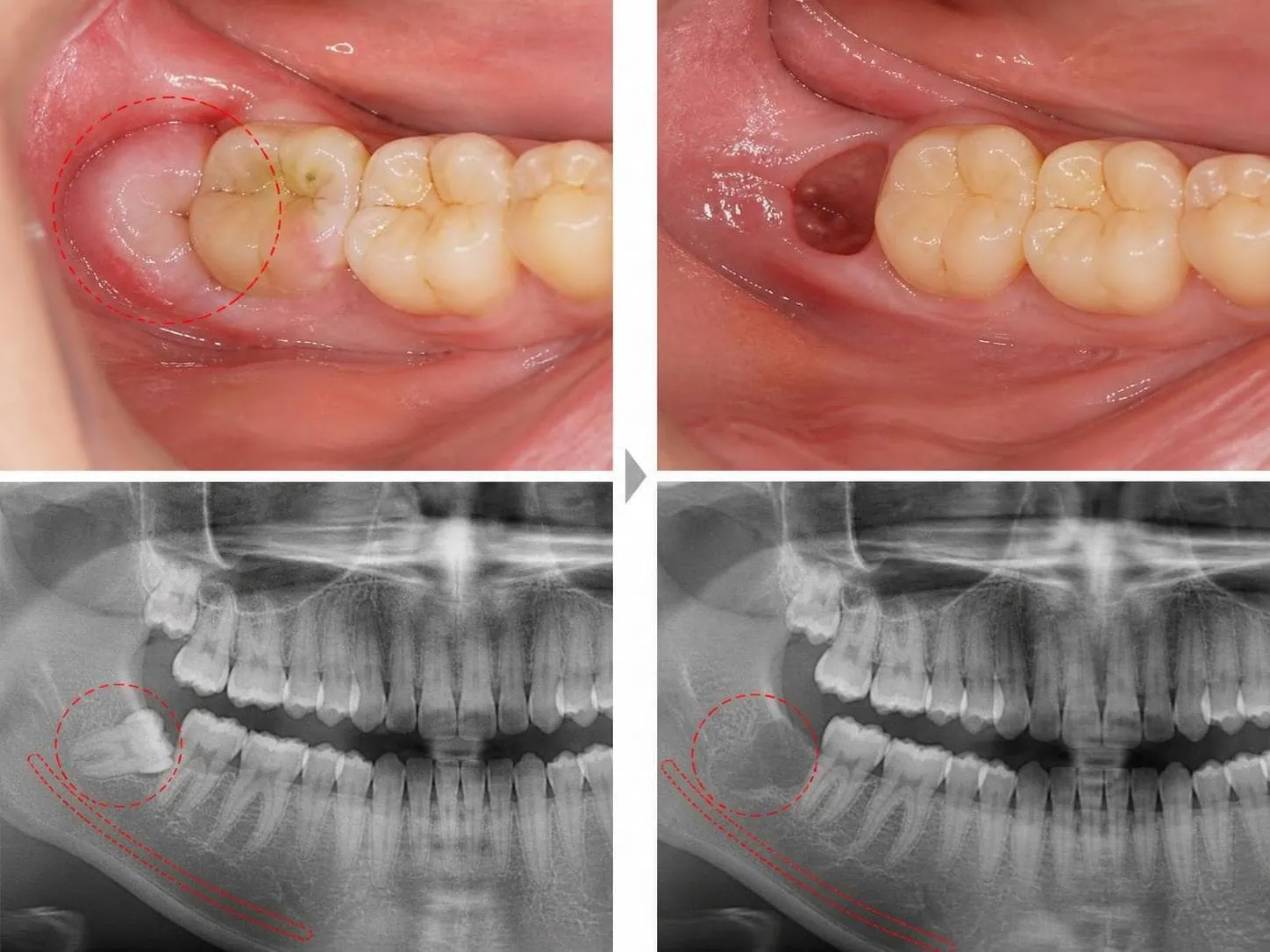 [경산 명치과] 명치과 (myungdental) 자연치아 살리기 메인 사랑니