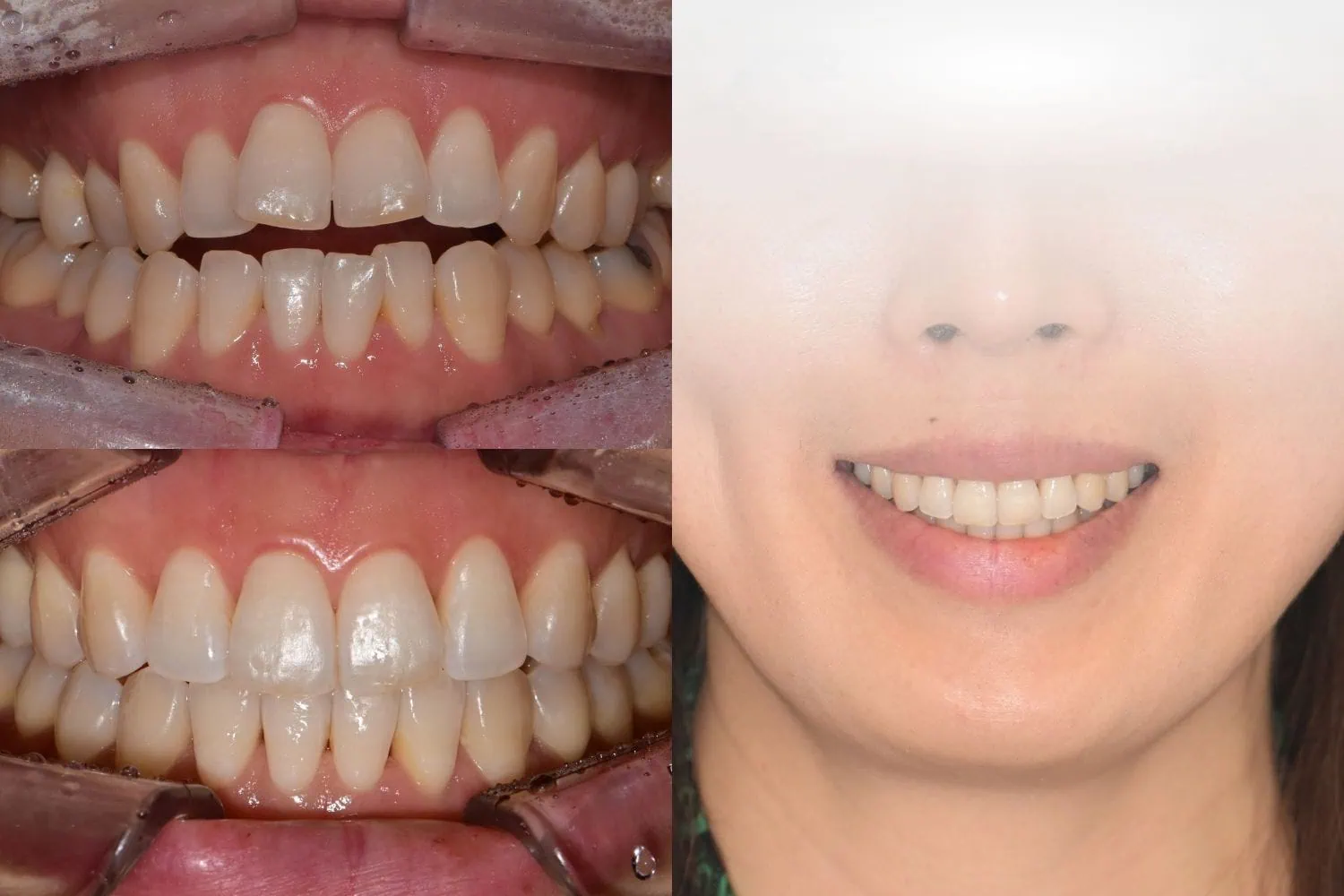 [경산 명치과] 명치과 (myungdental) 치아교정 개방교합