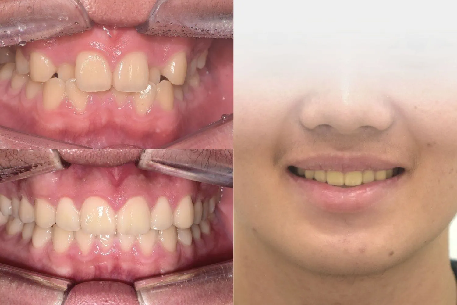[경산 명치과] 명치과 (myungdental) 치아교정 덧니