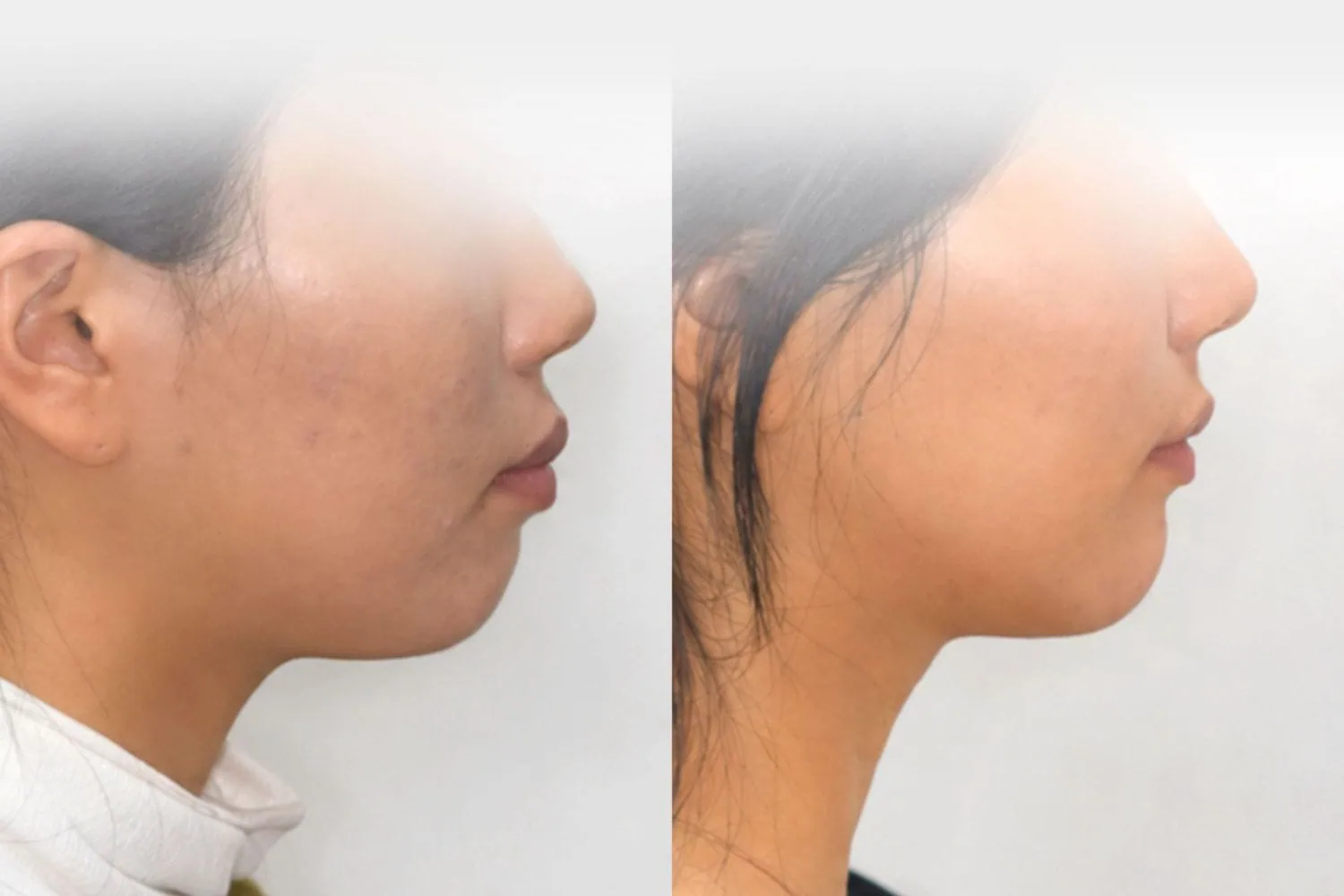 [경산 명치과] 명치과 (myungdental) 치아교정 돌출입