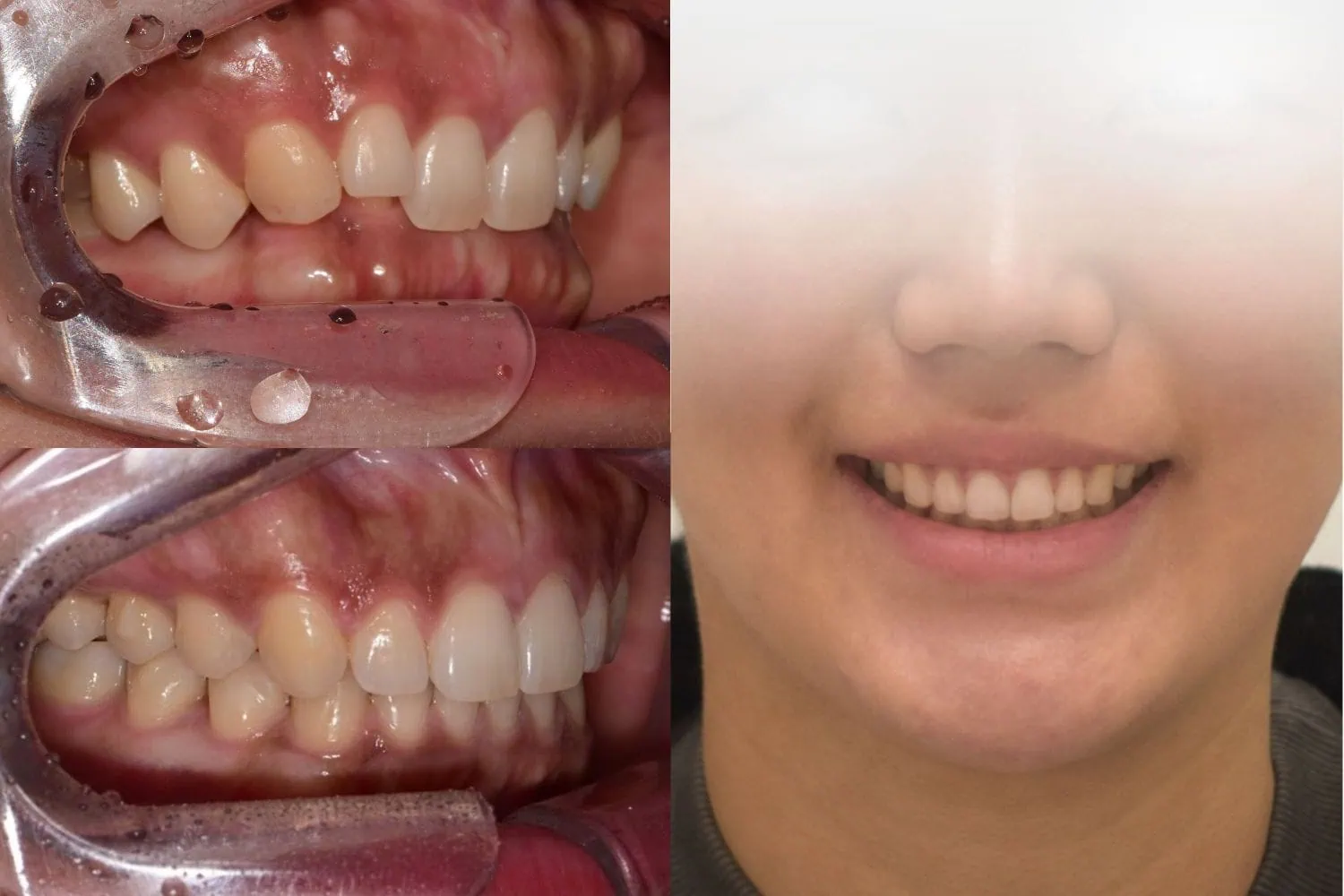 [경산 명치과] 명치과 (myungdental) 치아교정 딥바이트