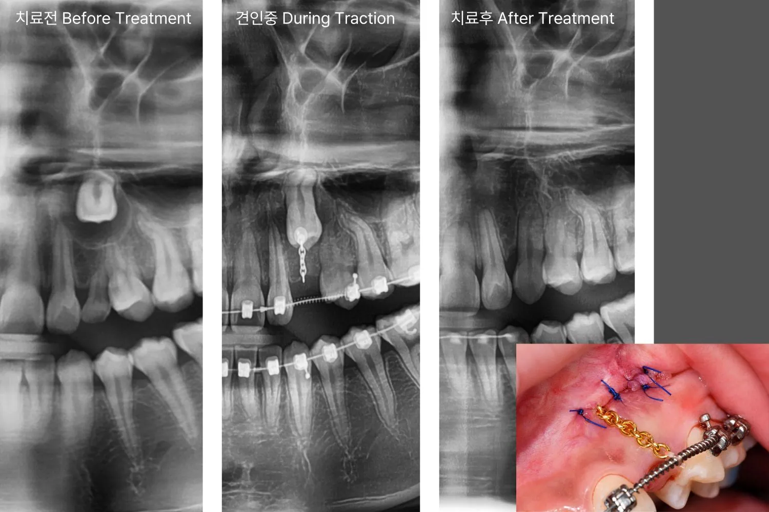 [경산 명치과] 명치과 (myungdental) 치아교정 매복치