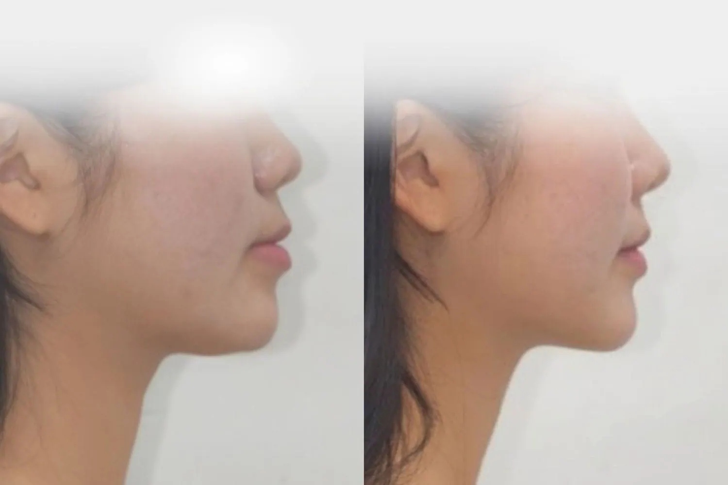 [경산 명치과] 명치과 (myungdental) 치아교정 주걱턱