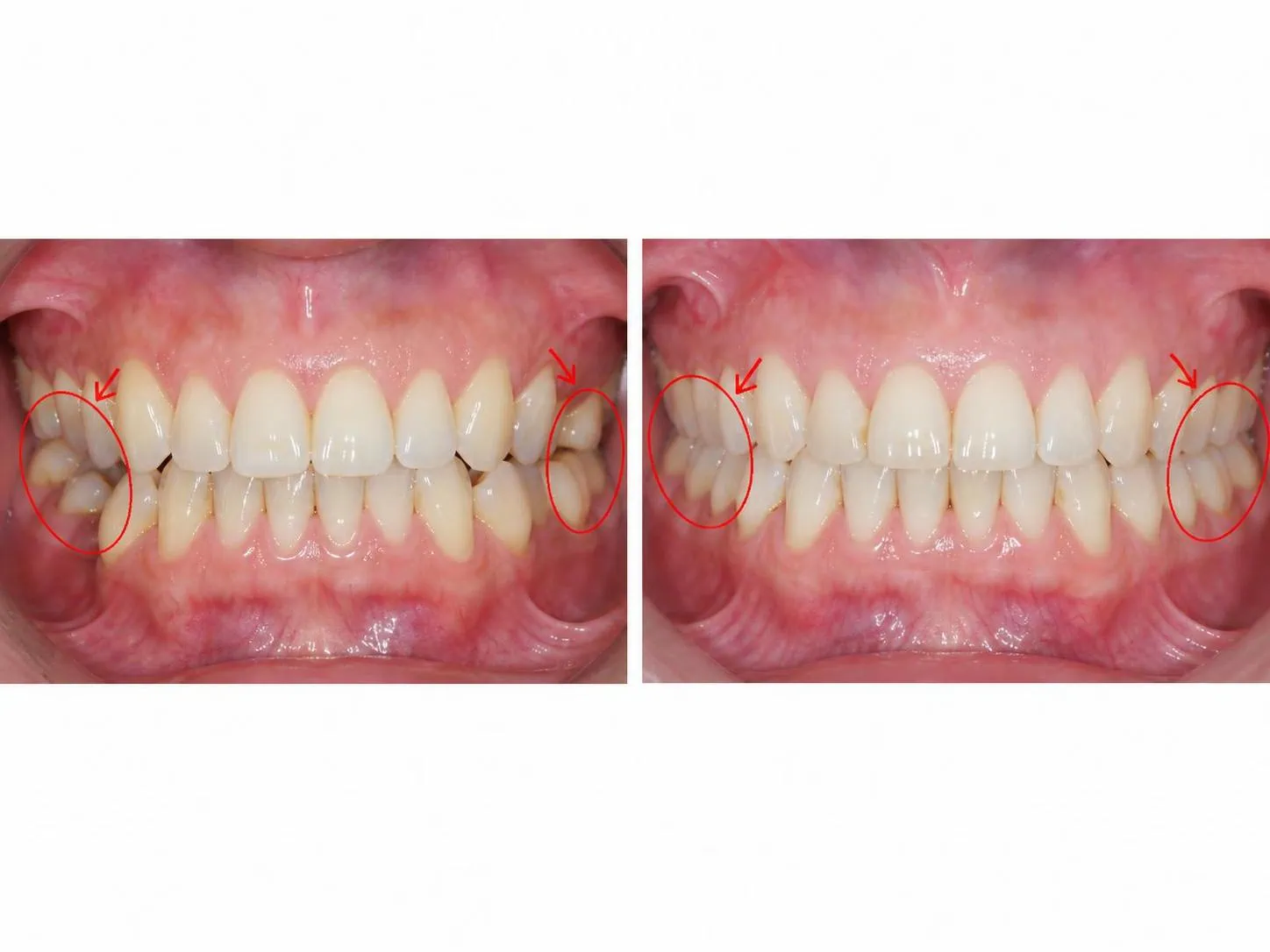 [경산 명치과] myungdental 소아교정 임플란트 수술 전 부분 교정 (어금니 세우기)