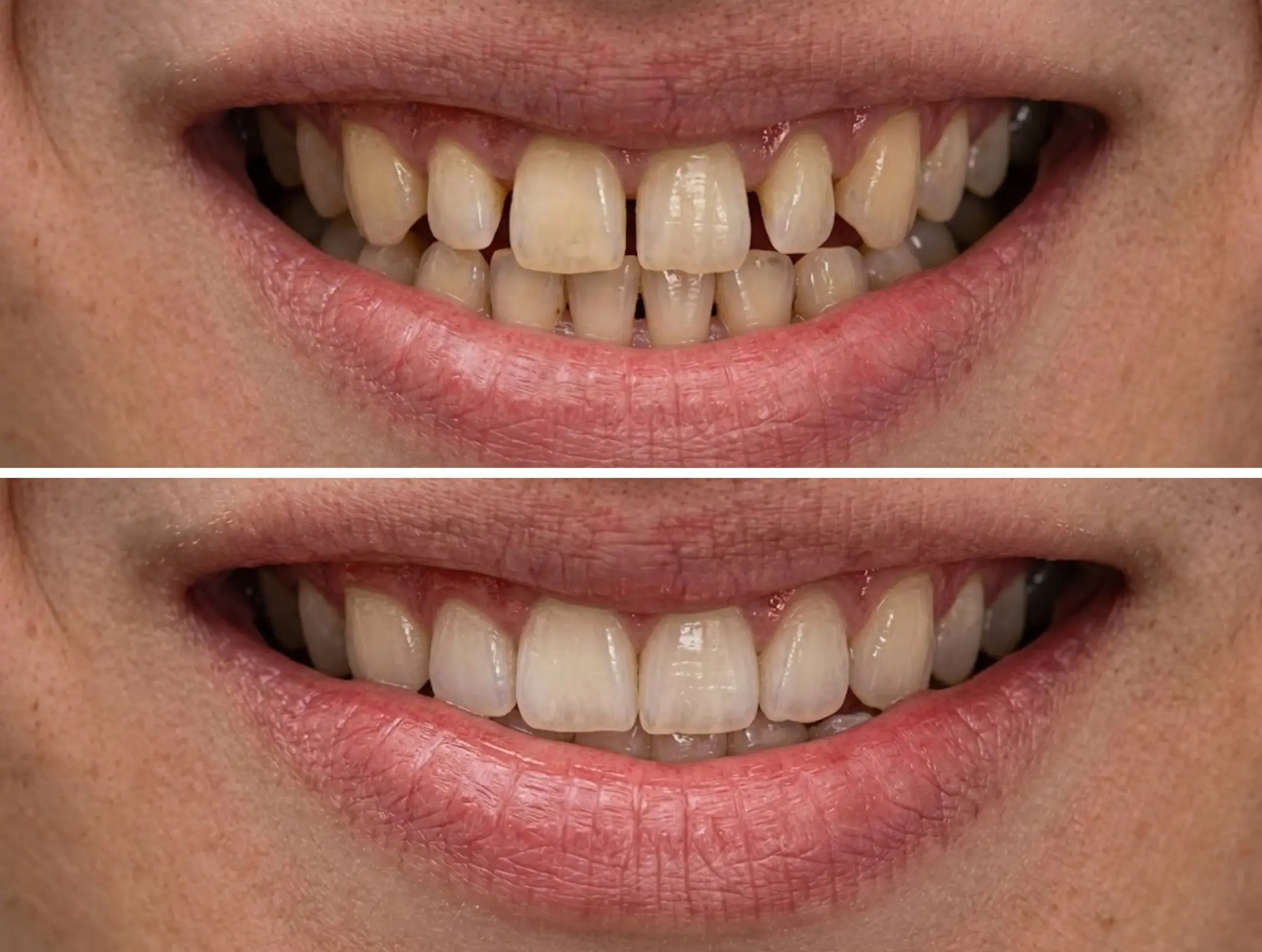 [경산 명치과] myungdental 심미치료 라미네이트2