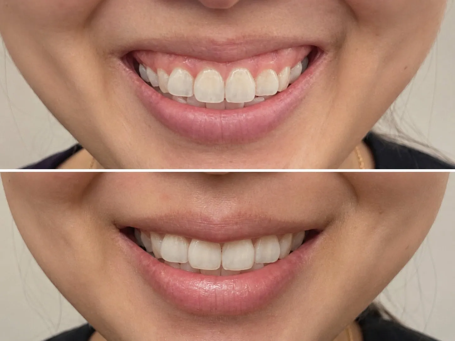 [경산 명치과] myungdental 심미치료 보톡스 거미1