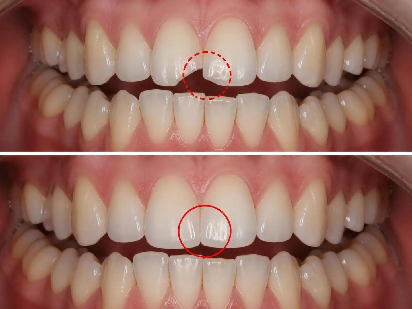 [경산 명치과] myungdental 앞니 레진 (6)