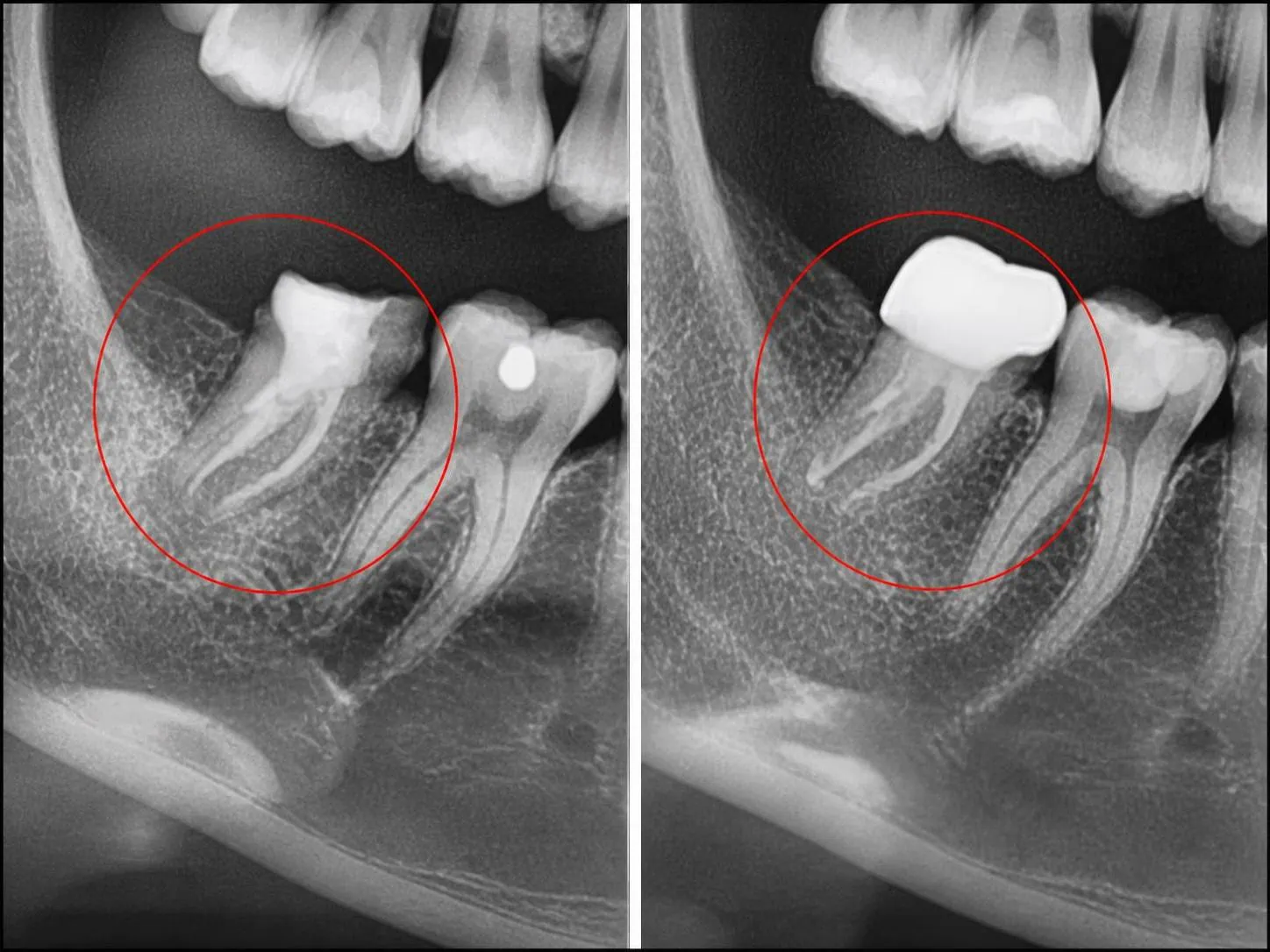 [경산 명치과] 명치과 (myungdental) 보존 보철 통합 치료 뿌리 끝 염증 완치 후 크라운 수복