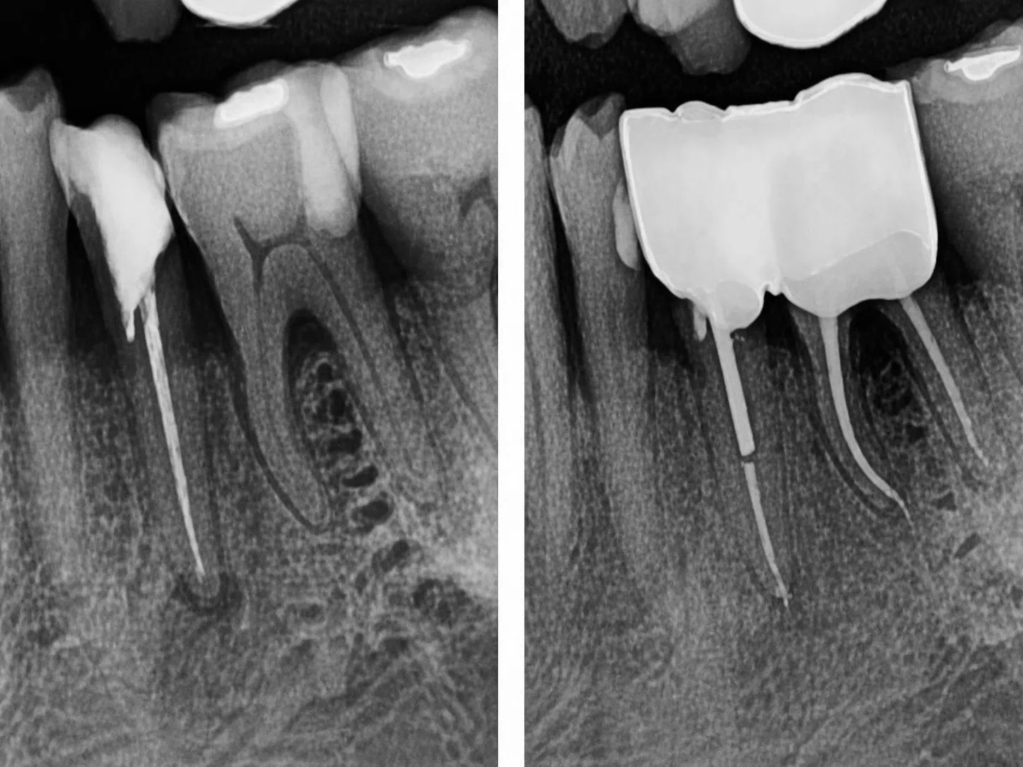 [경산 명치과] 명치과 (myungdental) 보존 보철 통합 치료 재신경치료 후 포스트 코어 수복