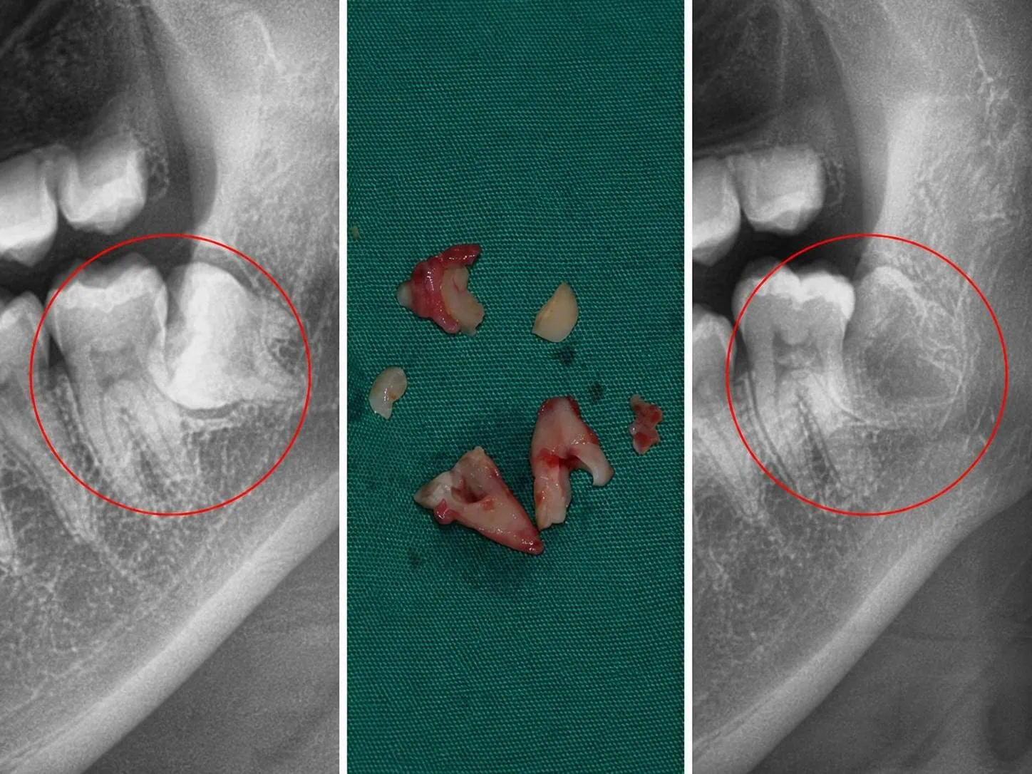 [경산 명치과] 명치과 (myungdental) 사랑니 신경관과 가까운 하악 수평매복 사랑니