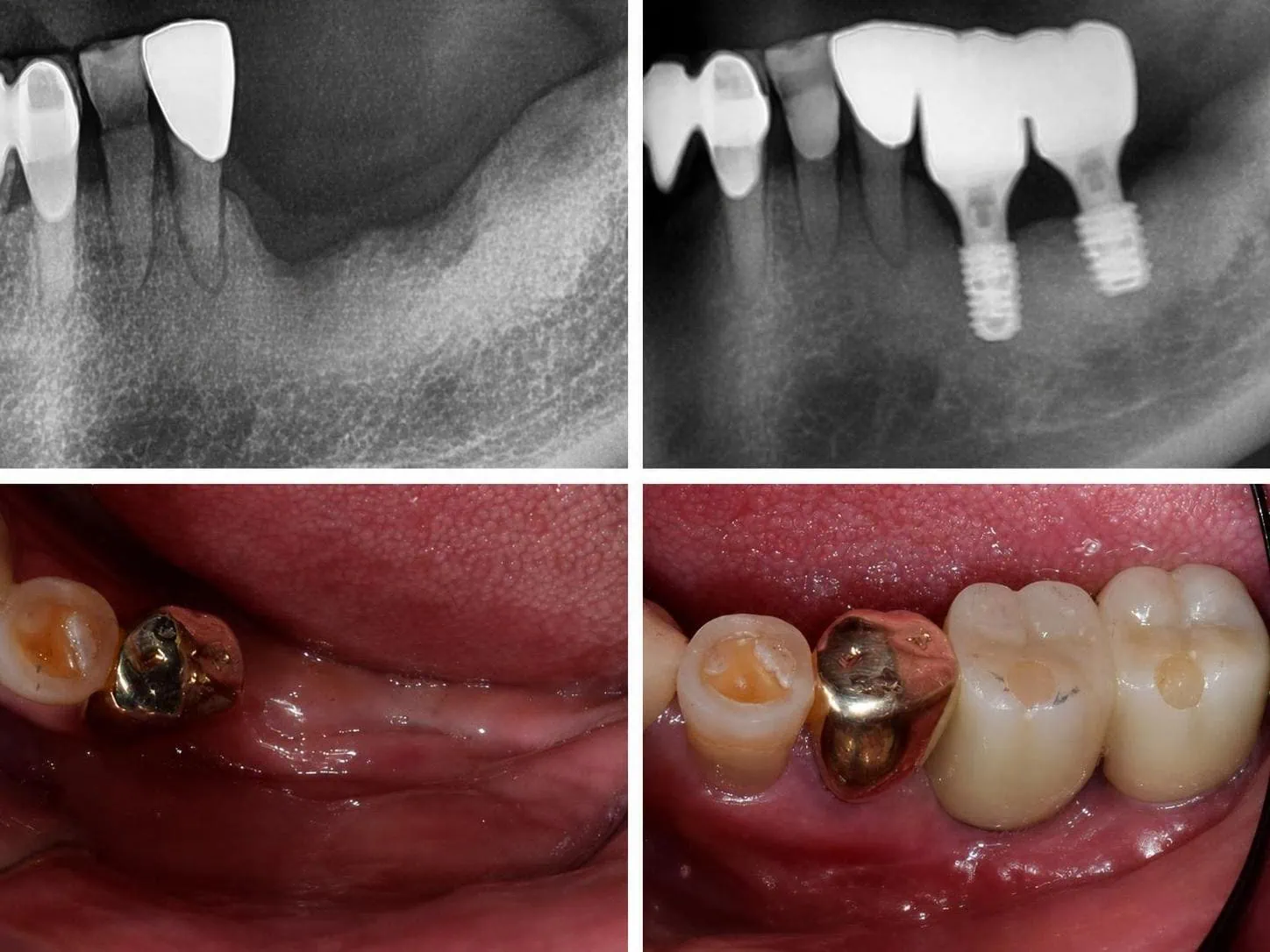 [경산 명치과] 명치과 (myungdental) 임플란트 메인(실사례) 고난도 뼈이식 임플란트