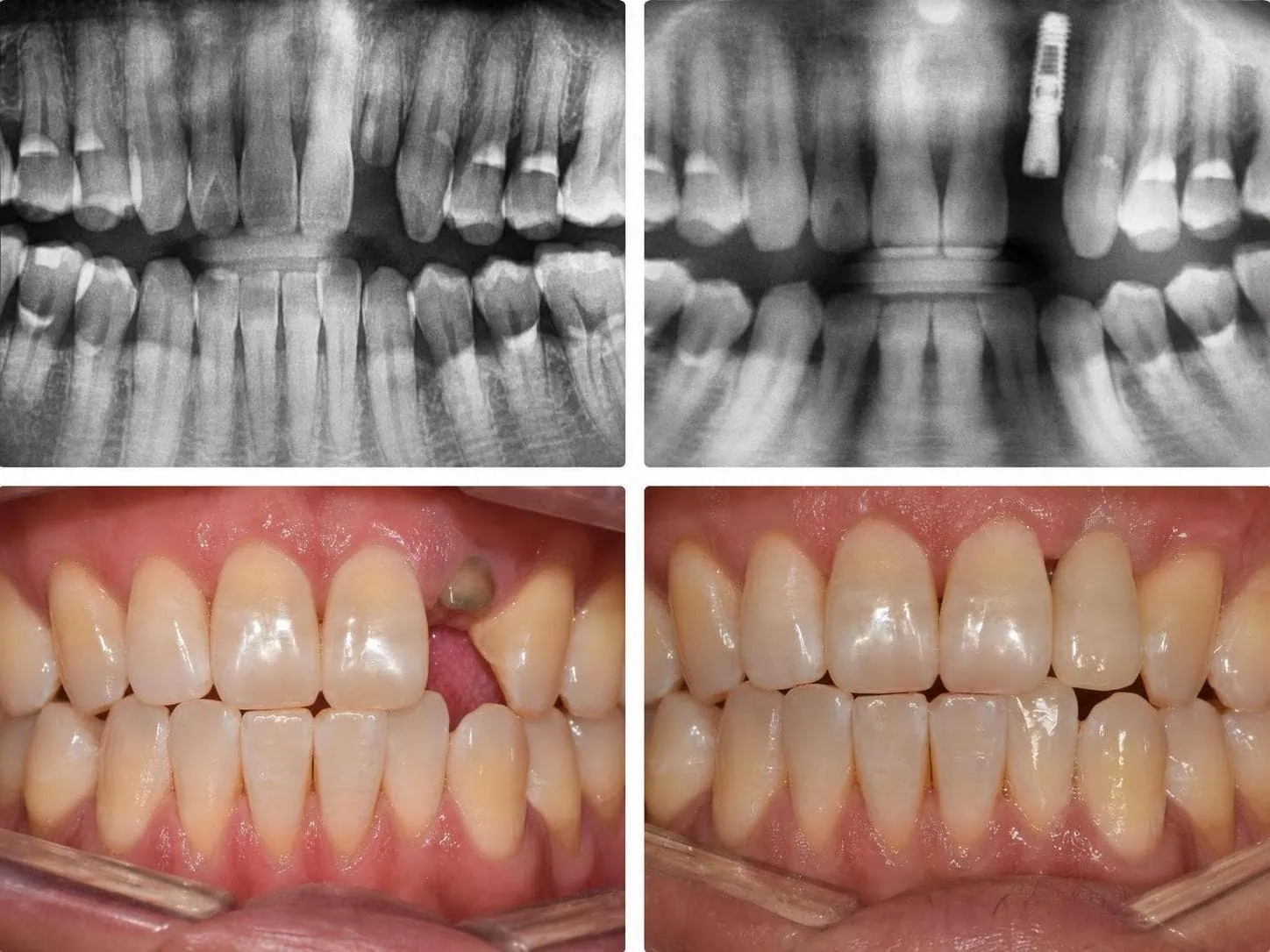 [경산 명치과] 명치과 (myungdental) 임플란트 메인(실사례) 발치 즉시 임플란트