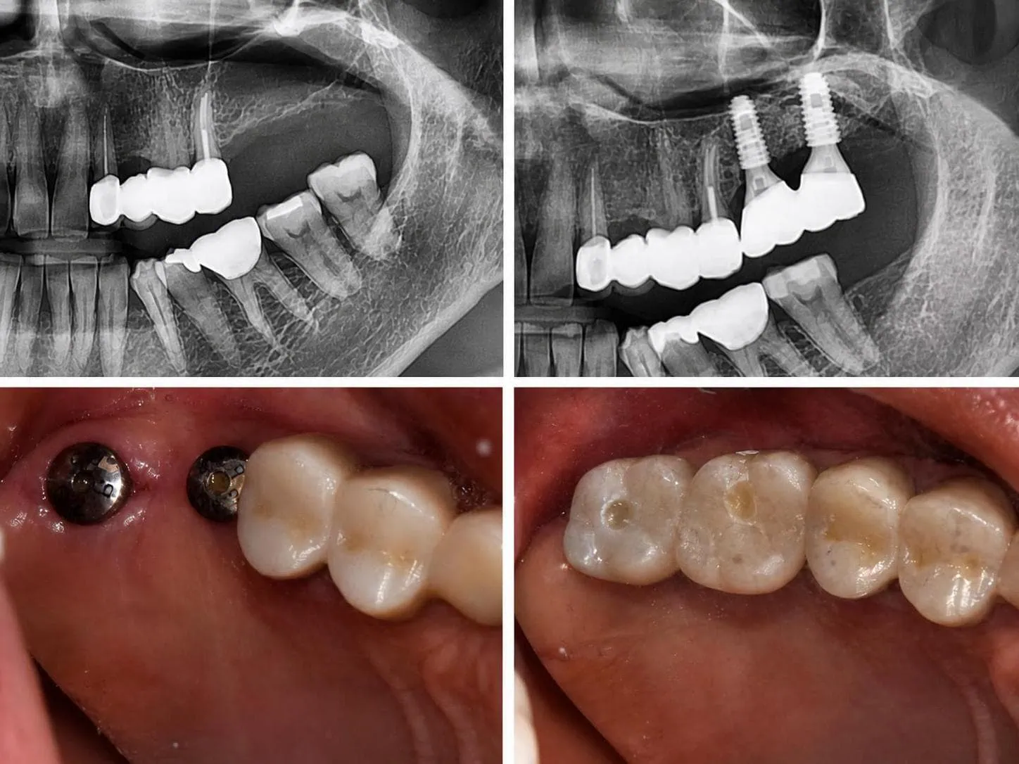 [경산 명치과] 명치과 (myungdental) 임플란트 메인(실사례) 상악동 거상술