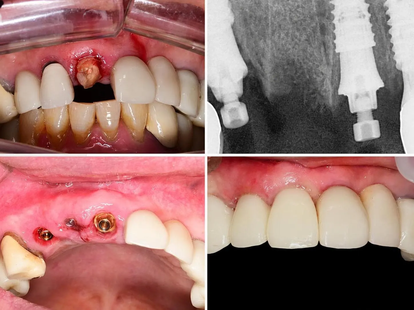 [경산 명치과] 명치과 (myungdental) 임플란트 메인(실사례) 시멘트리스 임플란트 보철