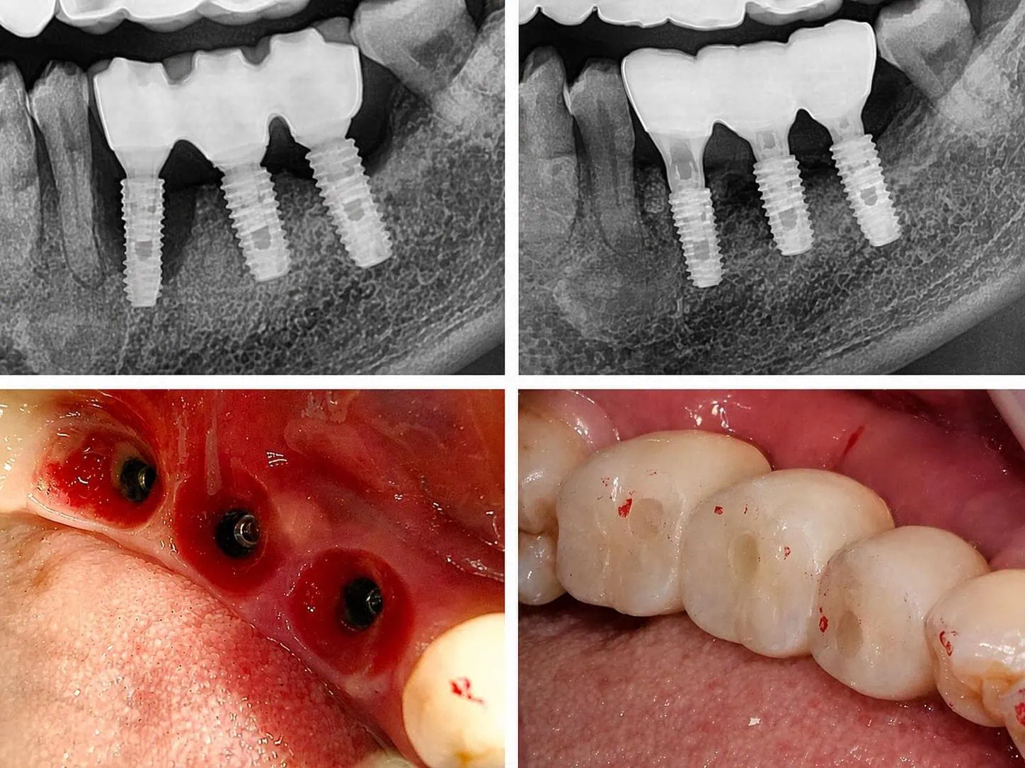 [경산 명치과] 명치과 (myungdental) 임플란트 메인(실사례) 임플란트 재수술 · 재건