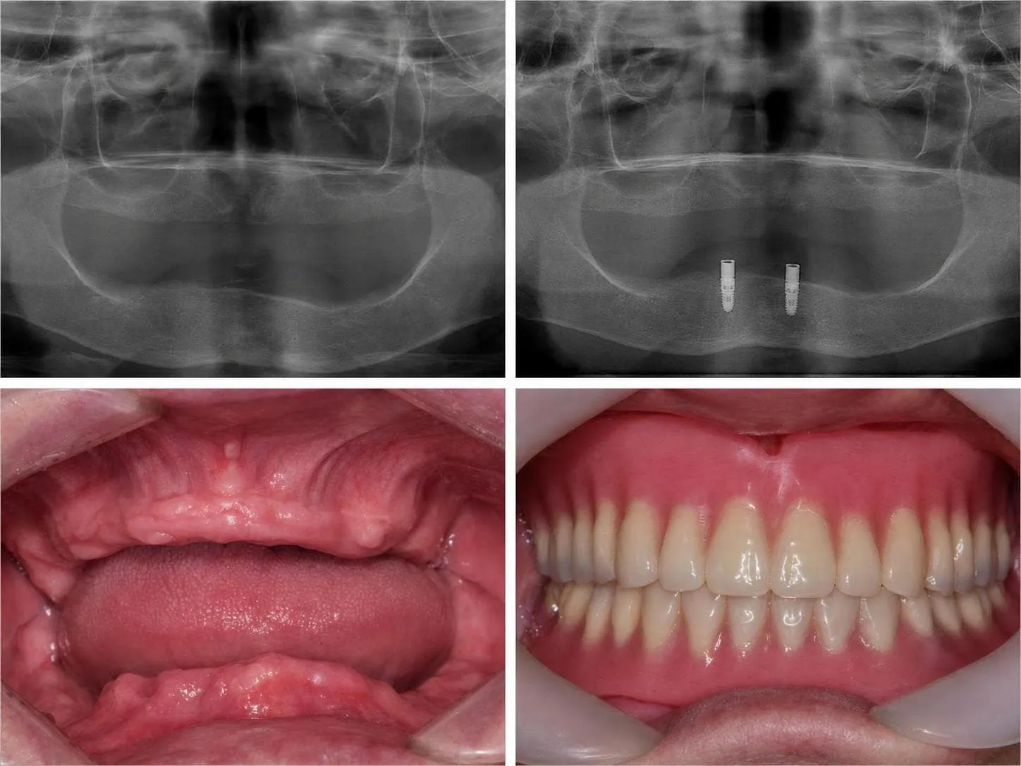 [경산 명치과] 명치과 (myungdental) 임플란트 메인(실사례) 임플란트 틀니