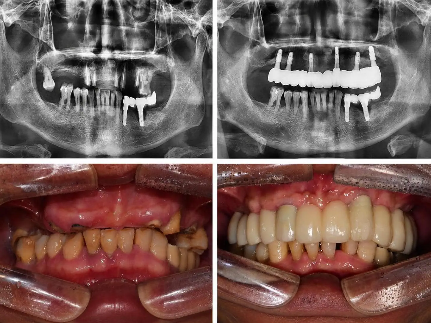 [경산 명치과] 명치과 (myungdental) 임플란트 메인(실사례) 전체 디지털 풀아치 임플란트