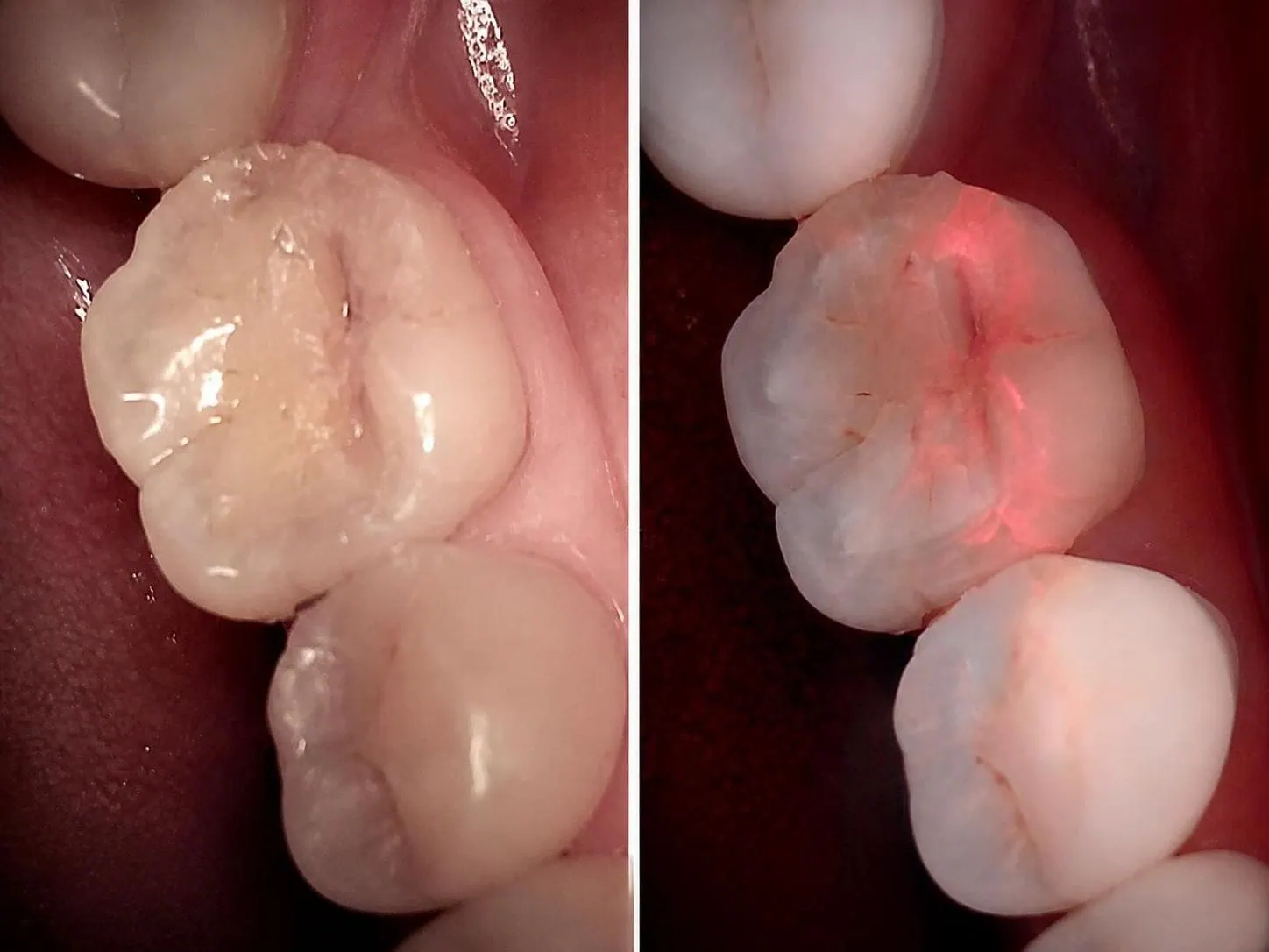 [경산 명치과] 명치과 (myungdental) 자연치아 살리기 메인(실사례) 큐레이 정밀진단