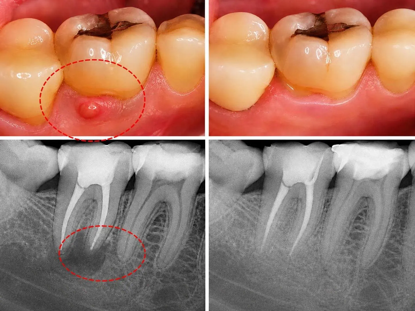 [경산 명치과] 명치과 (myungdental) 자연치아 살리기 메인(실사례) 플라즈마 신경치료