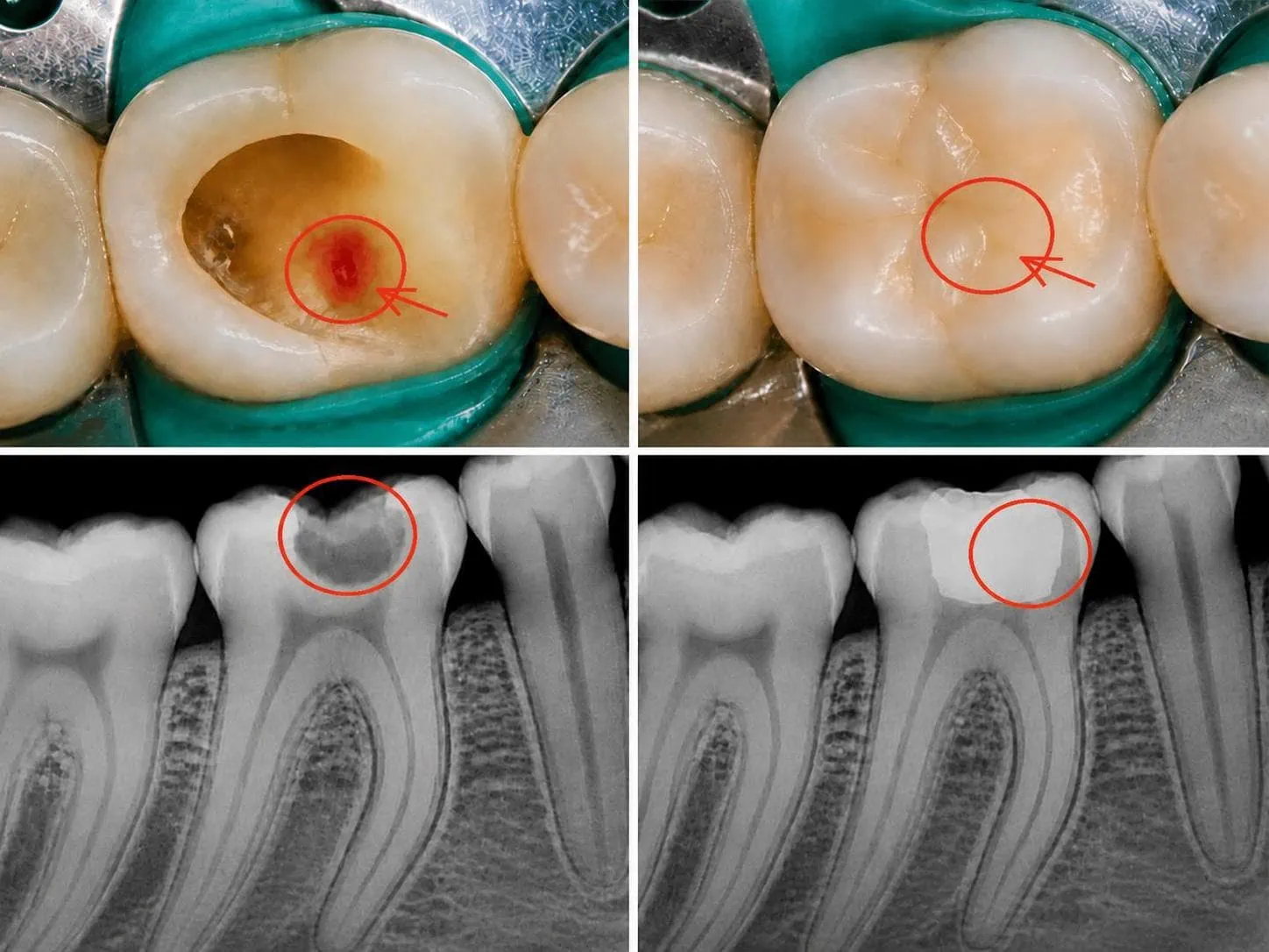 [경산 명치과] 명치과 (myungdental) 자연치아 살리기 메인(실사례) MTA 신경보호술