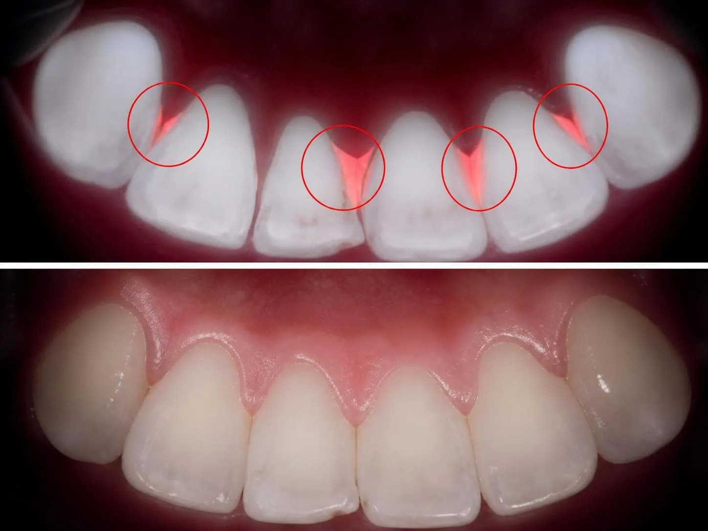 [경산 명치과] 명치과 (myungdental) 큐레이 정밀 진단 스케일링 잇몸치료 시 치석 확인