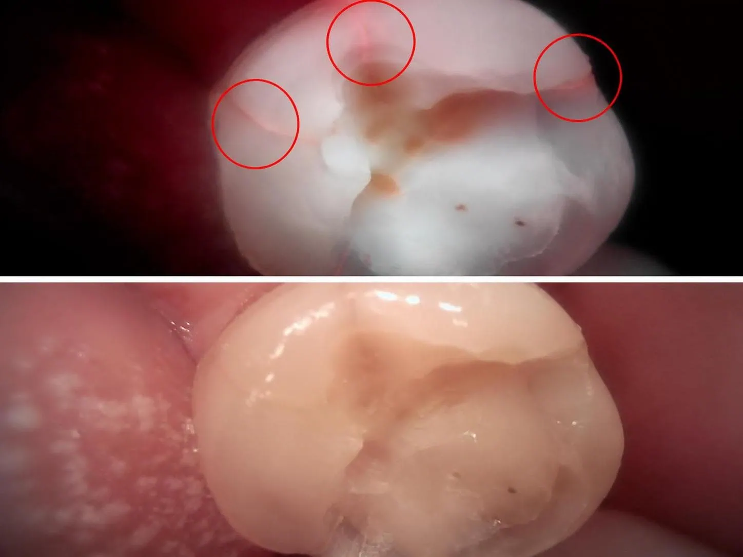[경산 명치과] 명치과 (myungdental) 큐레이 정밀 진단 육안으로 확인 불가능한 크랙 확인
