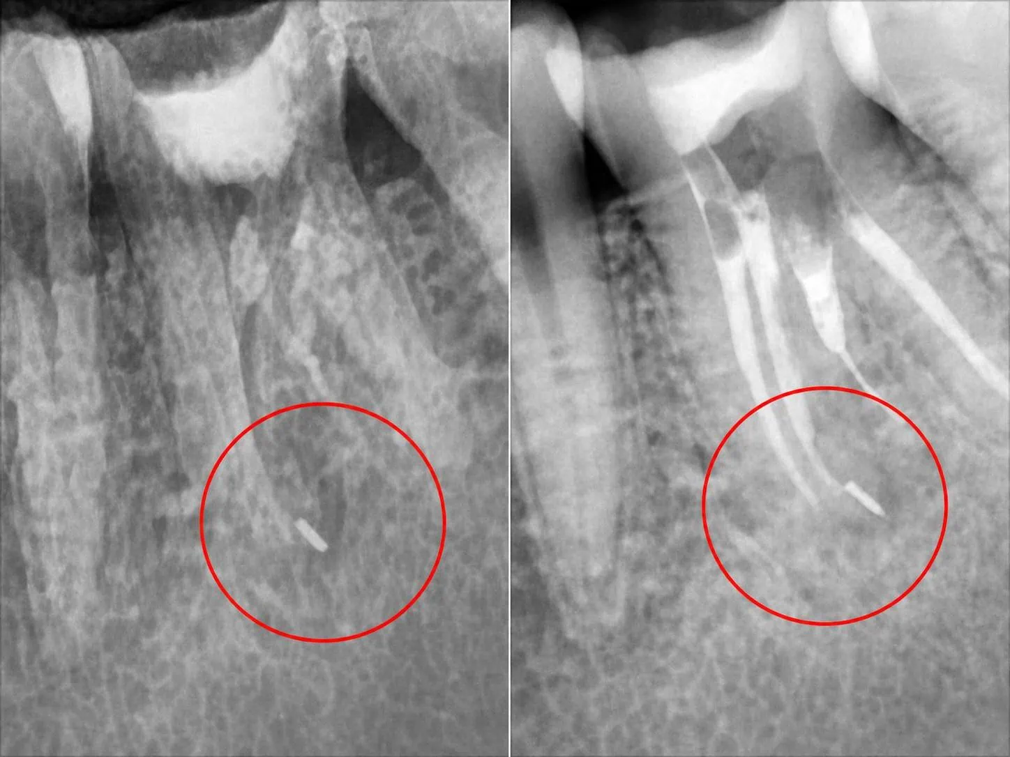 [경산 명치과] 명치과 (myungdental) 플라즈마 신경치료 까다로운 재신경치료