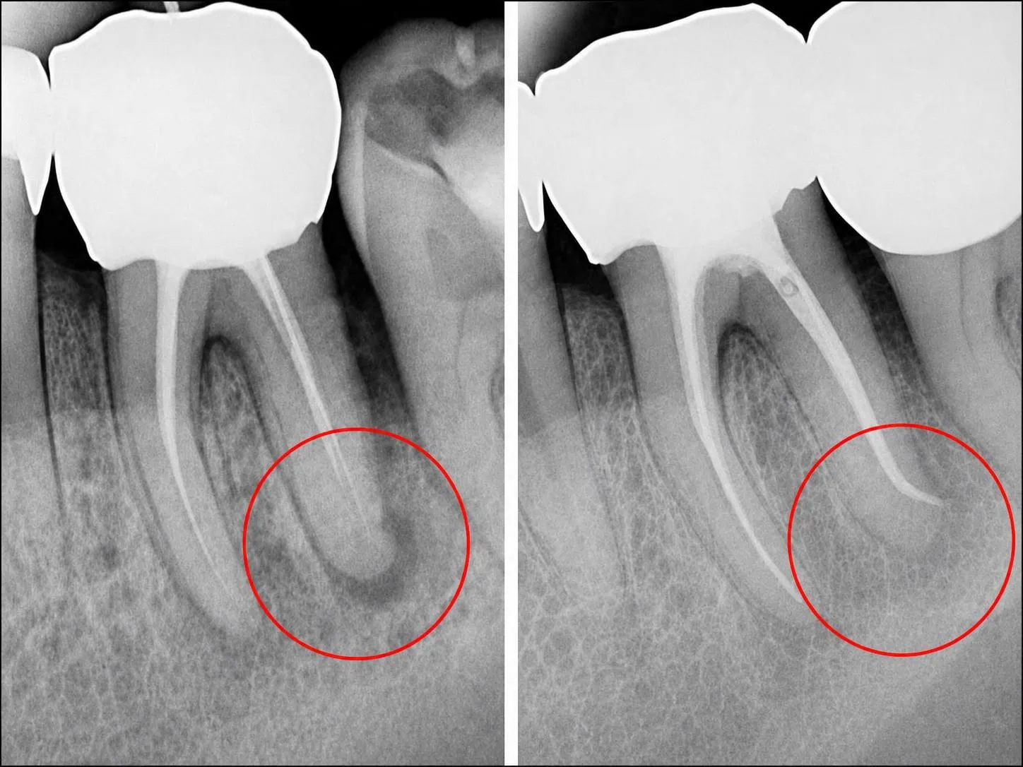 [경산 명치과] 명치과 (myungdental) 플라즈마 신경치료 심한 치근단 염증