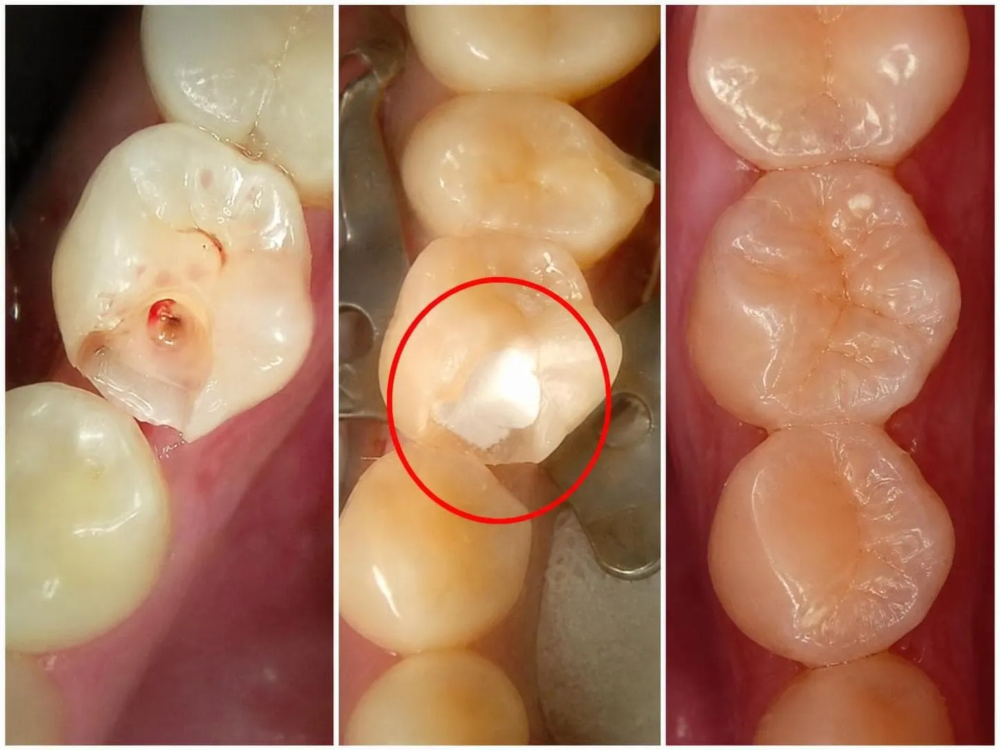 [경산 명치과] 명치과 (myungdental) MTA 신경보호술 깊은 우식 제거 후 치수(신경) 노출