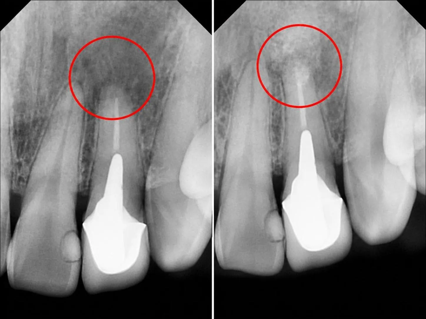 [경산 명치과] 명치과 (myungdental) MTA 신경보호술 MTA 치근단 수술
