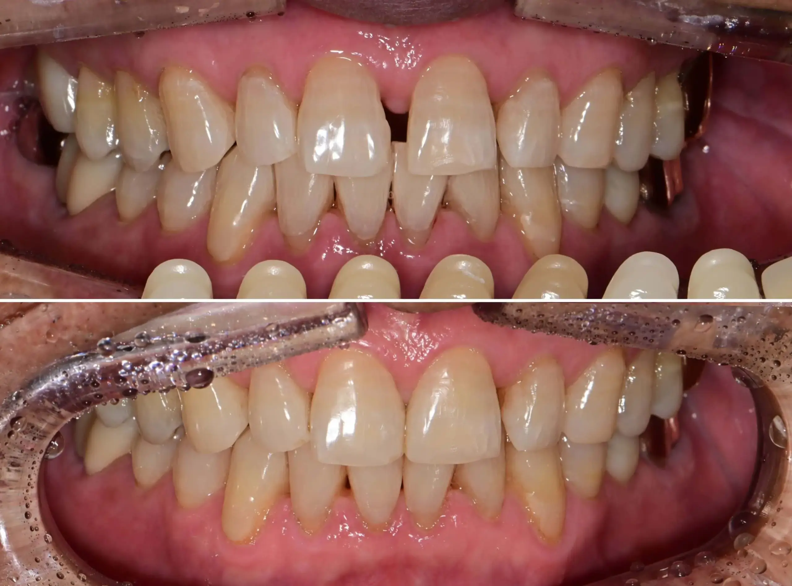 경산 명치과 myungdental 레진 esthetic resin