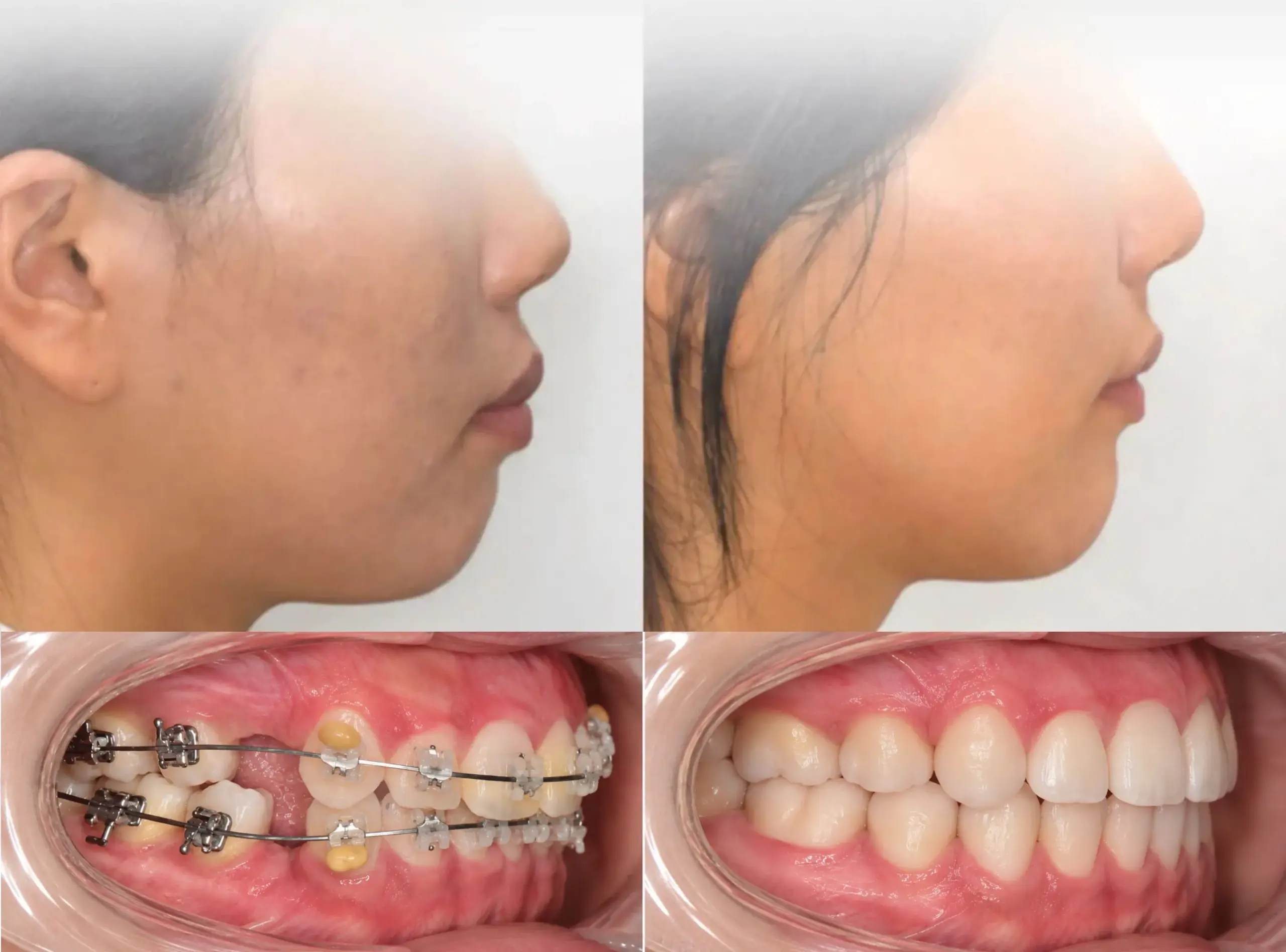 경산 명치과 myungdental 치아교정 자가결찰 돌출입