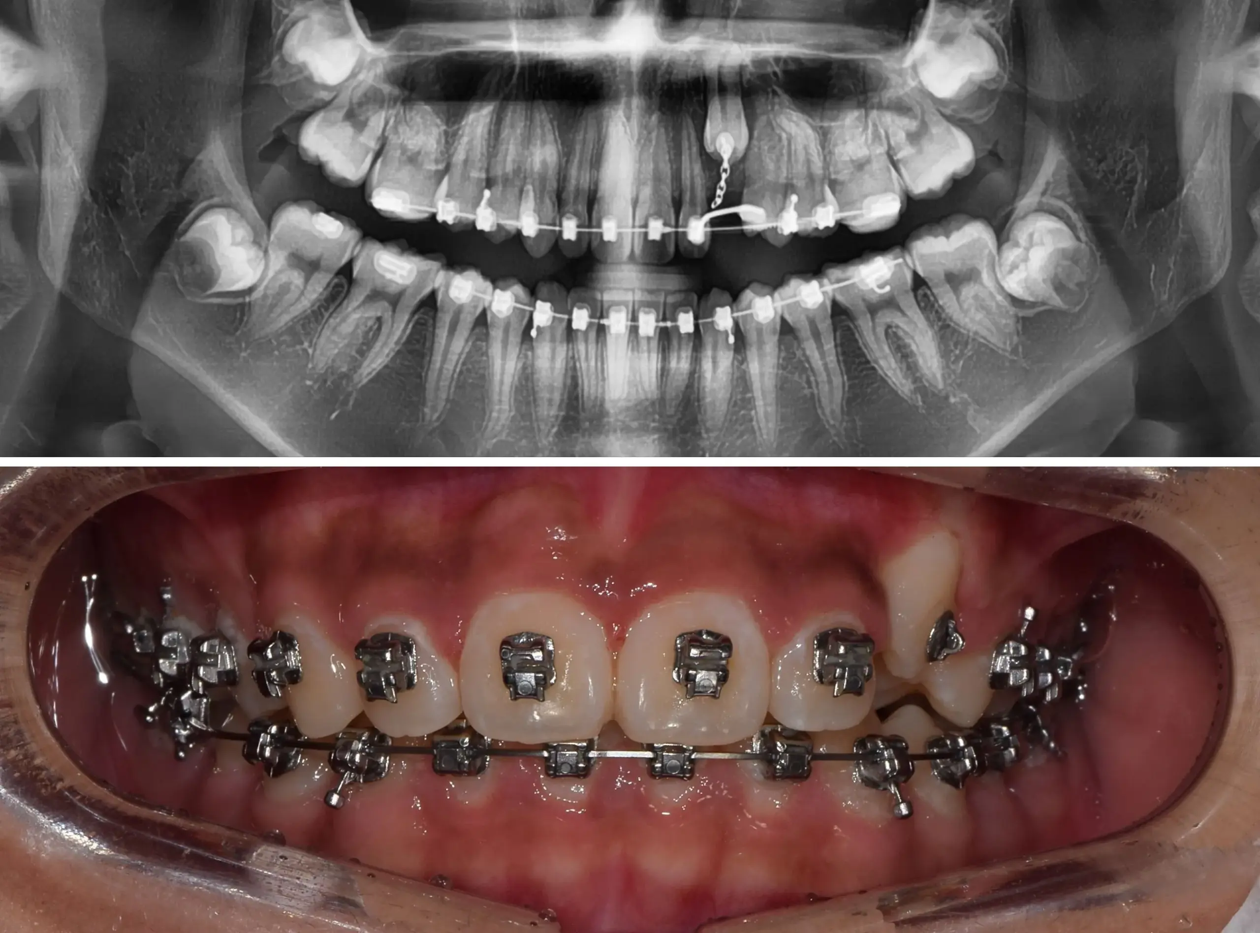경산 명치과 myungdental 치아교정 자가결찰 매복치