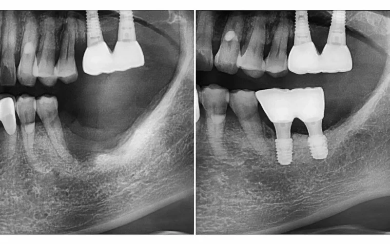 [경산 명치과] 명치과 -(myungdental) -임플란트 - 고난도뼈이식7