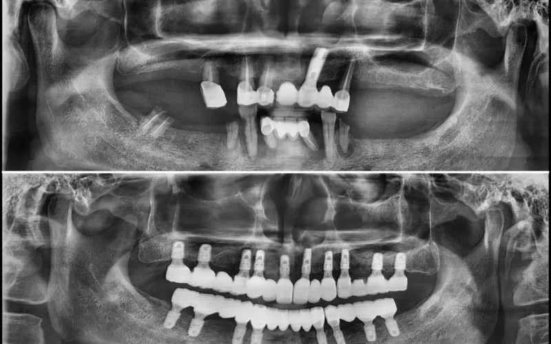 [경산 명치과] 명치과 -(myungdental) -임플란트 - 다수치아상실 전악임플란트 회복1