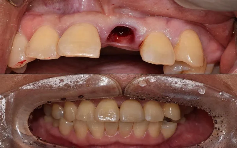 [경산 명치과] 명치과 -(myungdental) -임플란트 - 발치즉시임플란트3