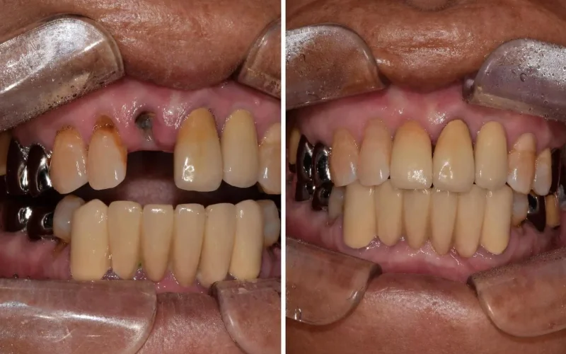 [경산 명치과] 명치과 -(myungdental) -임플란트 - 발치즉시 임플란트4