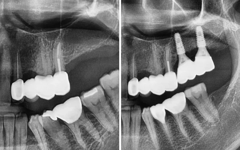 [경산 명치과] 명치과 -(myungdental) -임플란트 - 상악동거상술5