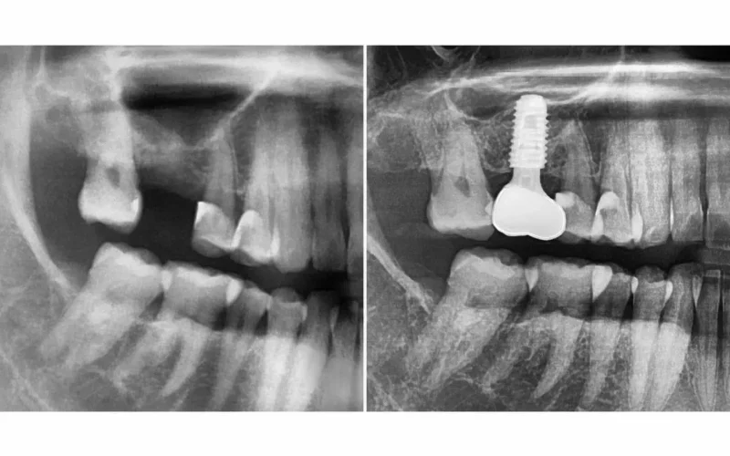 [경산 명치과] 명치과 -(myungdental) -임플란트 - 상악동거상술6