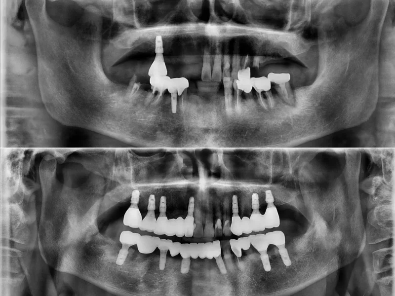 [경산 명치과] 명치과 -(myungdental) -임플란트 - 시멘트리스임플란트보철10