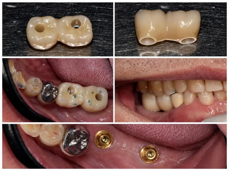 [경산 명치과] 명치과 -(myungdental) -임플란트 - 시멘트리스임플란트보철9