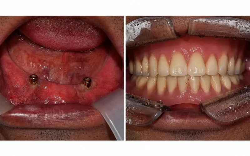 [경산 명치과] 명치과 -(myungdental) -임플란트 - 임플란트틀니-로케이터방식11