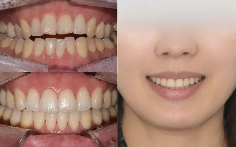 경산 명치과 명치과 myungdental 치아교정 개방교합