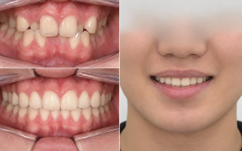 경산 명치과 명치과 myungdental 치아교정 덧니 (1)
