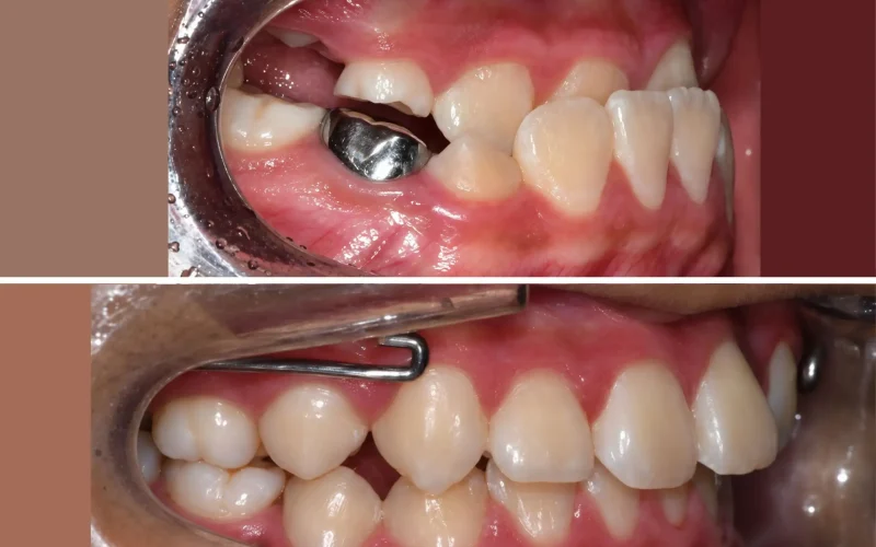 경산 명치과 myungdental 치아교정 소아교정 주걱턱