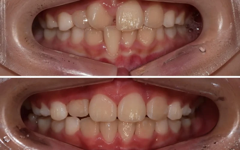 경산 명치과 myungdental 치아교정 소아교정 치은퇴축